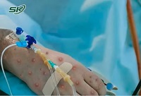 Bệnh nhân đầu tiên mắc đậu mùa khỉ tại Việt Nam là nữ, khởi phát bệnh khi đang đi du lịch